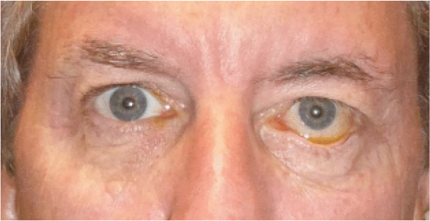 Image of eyes before surgery