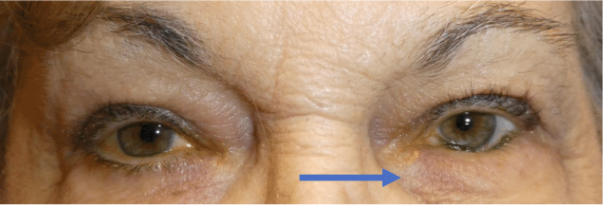 Image of eye before surgery