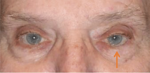Image of eye before surgery