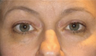 Patients eyes before surgery