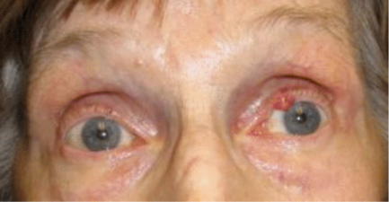 Patient before eyelid cancer reconstruction