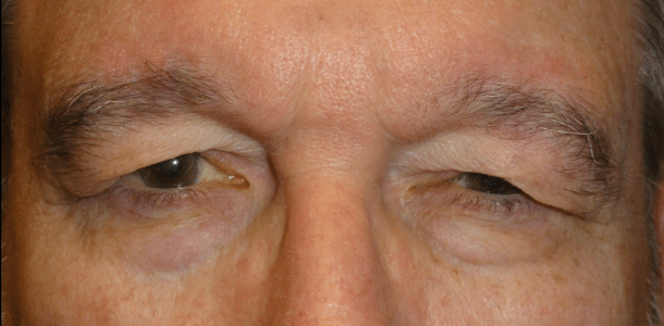 Patient before surgery with heavy upper eyelids