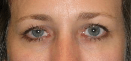 Patient with ptosis before surgery