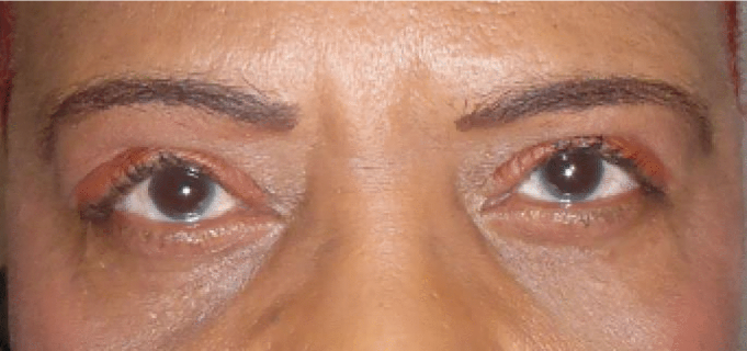 patient after upper eyelid ptosis surgery
