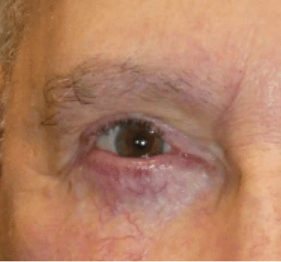 Image of eye after surgery