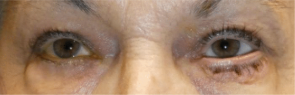 Image of eye with sutures after surgery