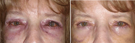 Eyes after surgery, with bruising and healing