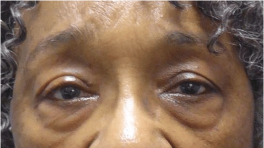 patient after upper eyelid ptosis surgery