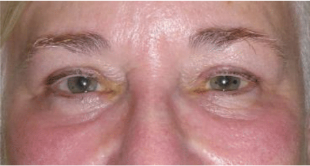 Improvement of eye shaper 1 month after surgery