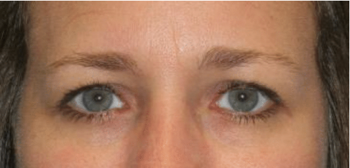 right upper eyelid ptosis repair