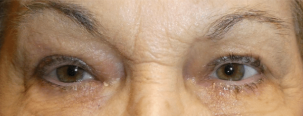 Image of eye healed after surgery