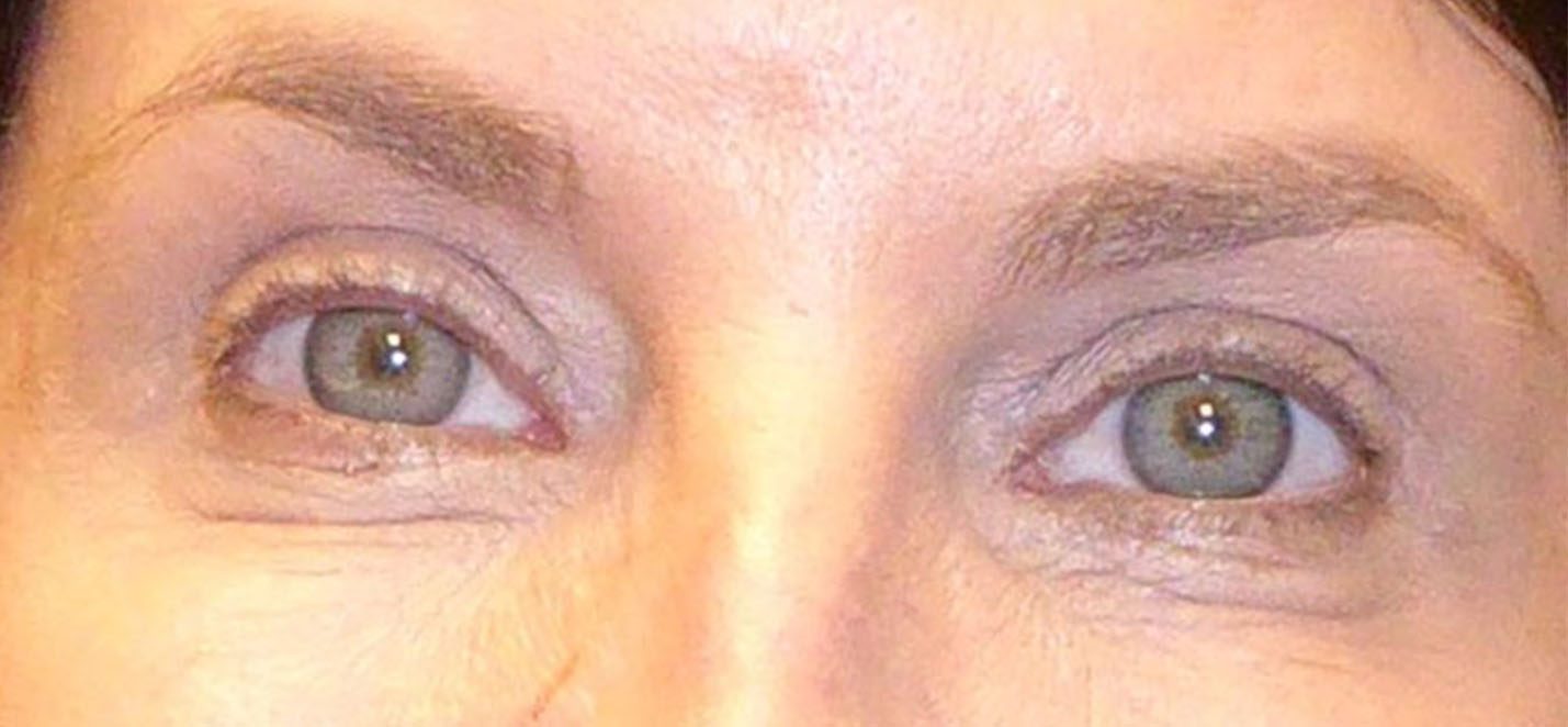 Upper Eyelid Blepharoplasty Before and After The Aesthetics Center The Aesthetics Center