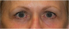 3 months after undergoing a lower eyelid blepharoplasty