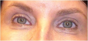 3 months after undergoing lower eyelid blepharoplasty