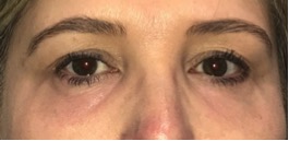 3 months after a lower eyelid blepharoplasty