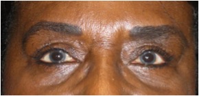 6 months after undergoing a lower eyelid blepharoplasty