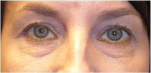 before undergoing a lower eyelid blepharoplasty