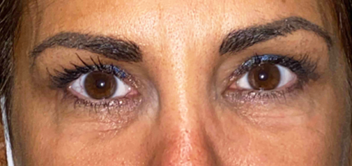 VEI Aesthetic Center Ptosis Repair Before & After (Post-Treatment)