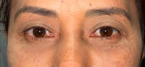 VEI Aesthetics - Lower Blepharoplasty with Fat Transfer - After Surgery