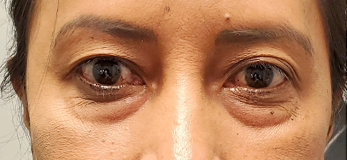 VEI Aesthetics - Lower Blepharoplasty with Fat Transfer - Before Surgery