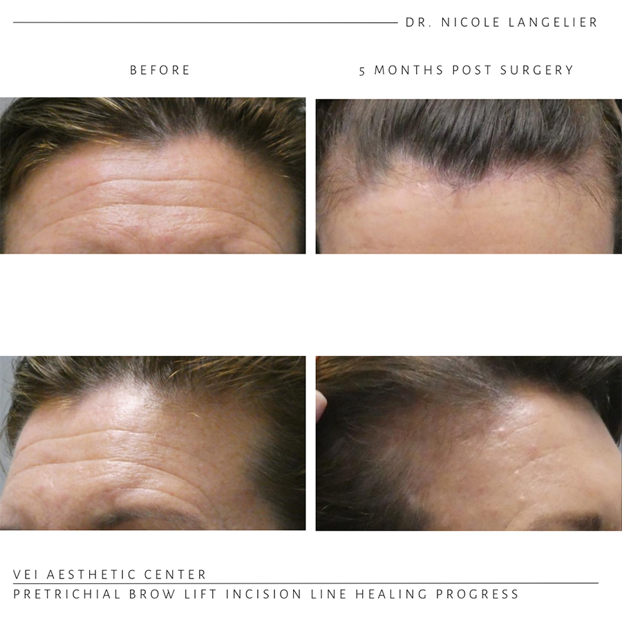 Pretrichial Brow Lift Before & After
