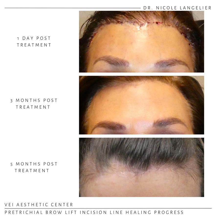 Pretrichial Brow Lift Before & After