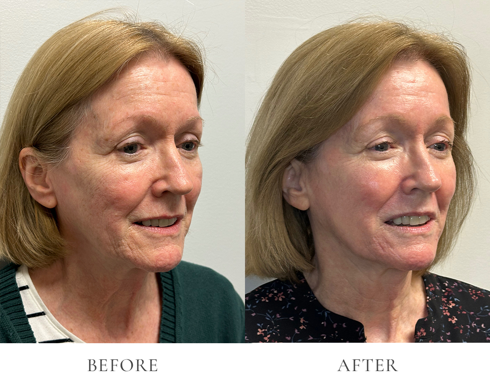 VEI Aesthetics - Sciton HALO/BBL/Sculptra Before & After