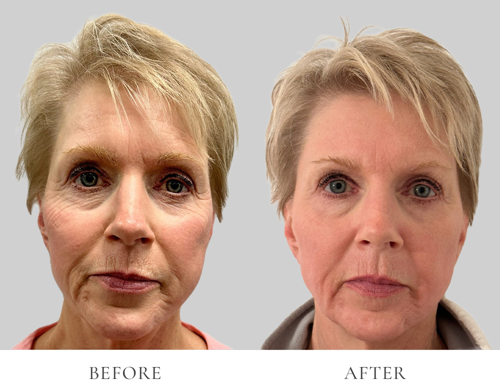 VEI Aesthetics - Sciton HALO/BBL/Sculptra Before & After