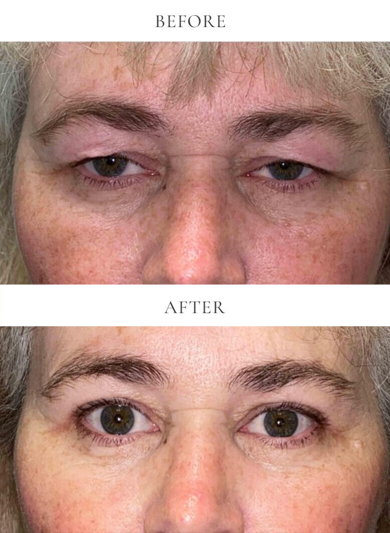 Upper eyelid blepharoplasty with internal brow lift before and after