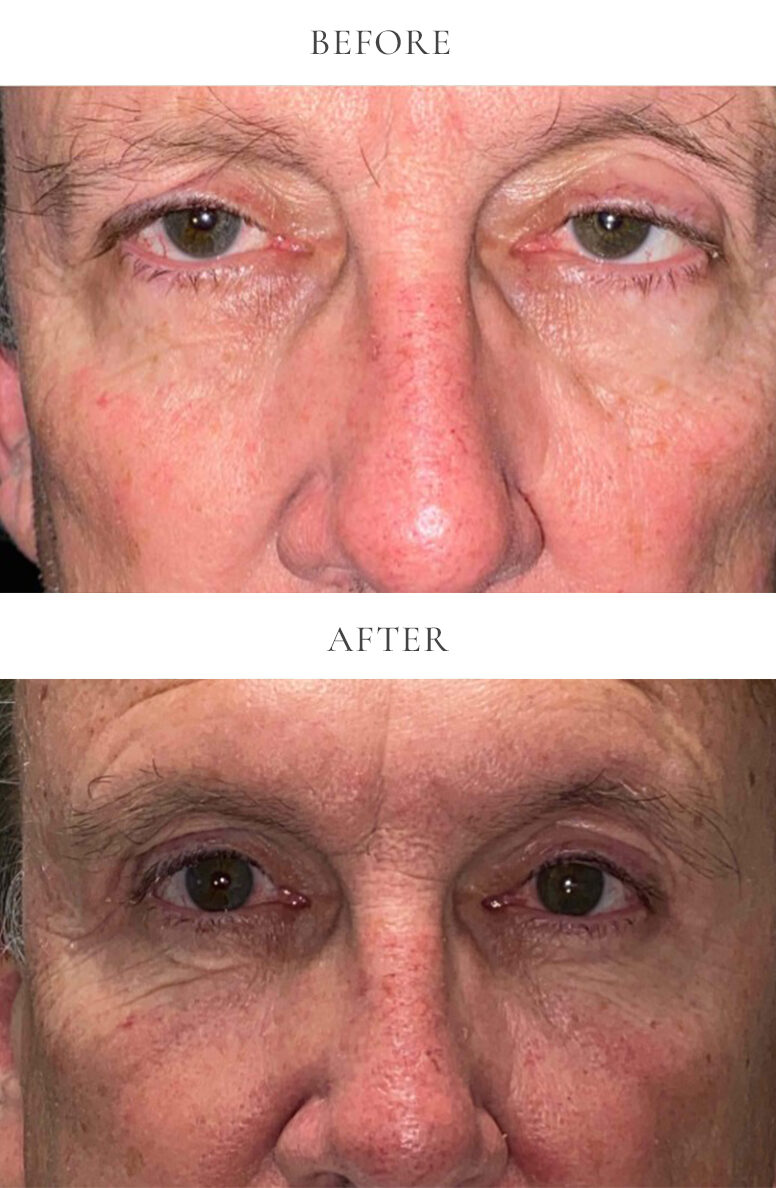 Upper eyelid blepharoplasty before and after