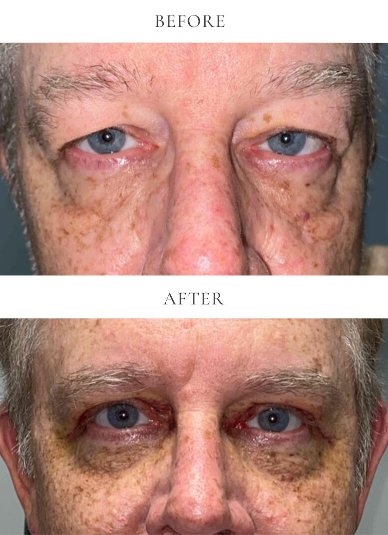 Upper eyelid bleph before and after