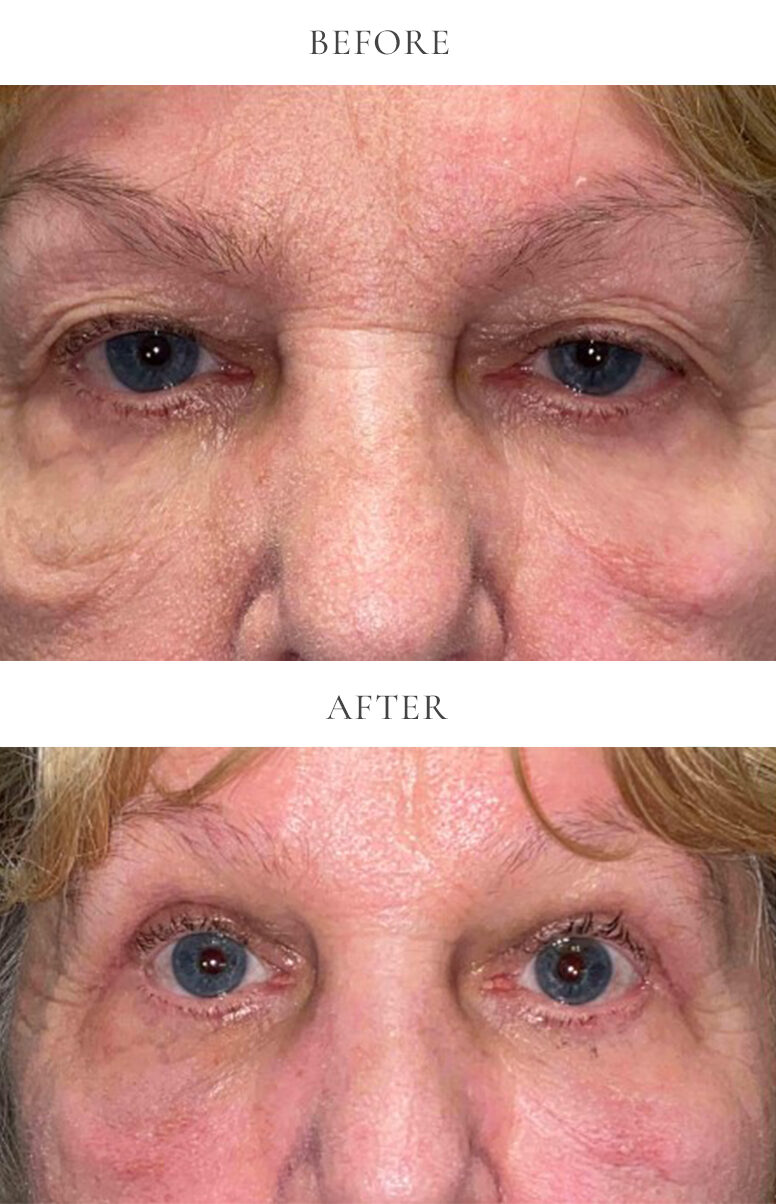 upper eyelid bleph before and after