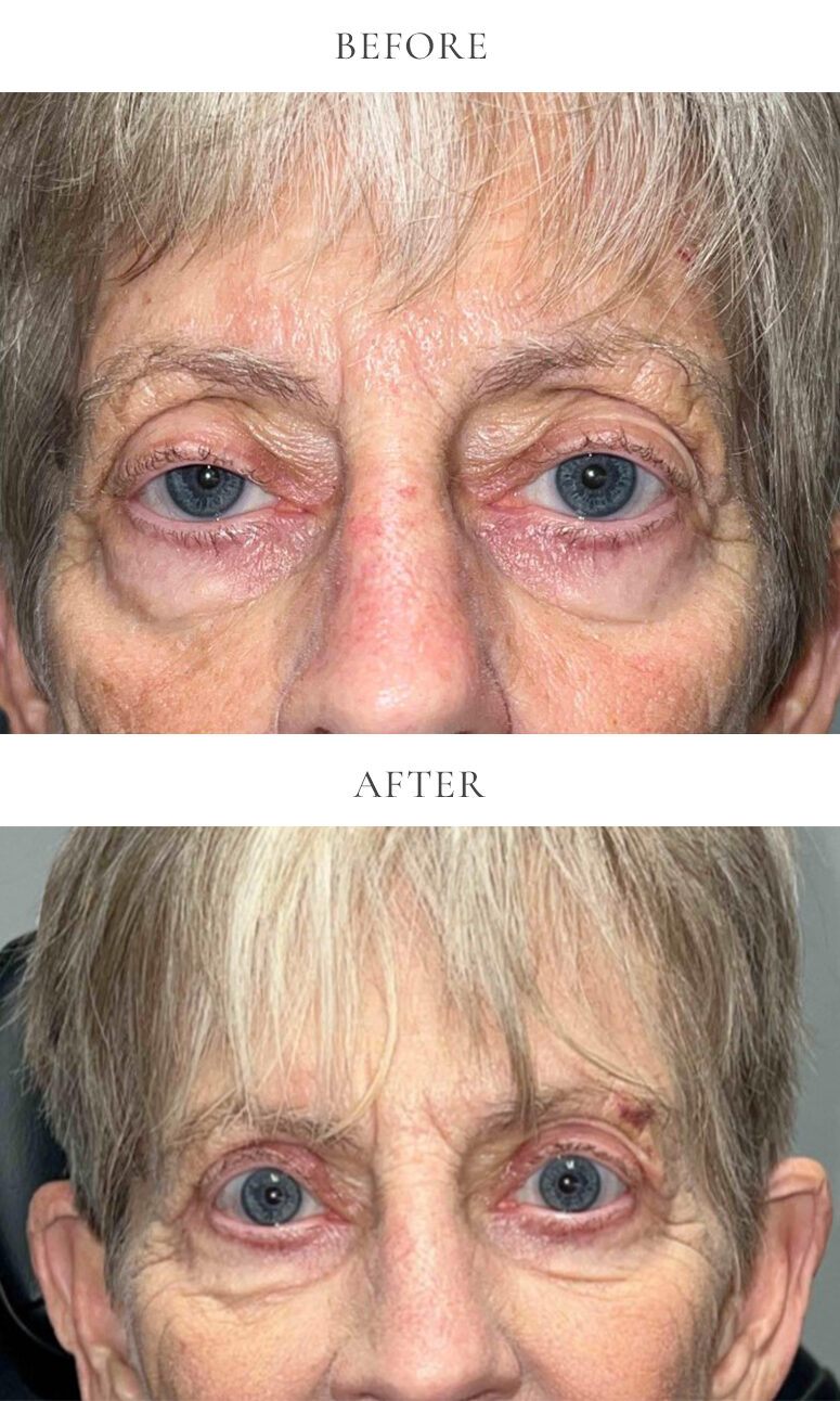 upper eyelid blepharoplasty before and after