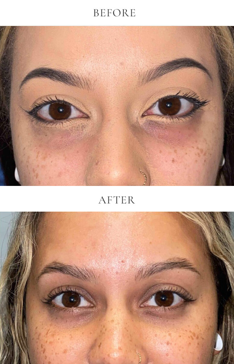 lower eyelid bleph before and after