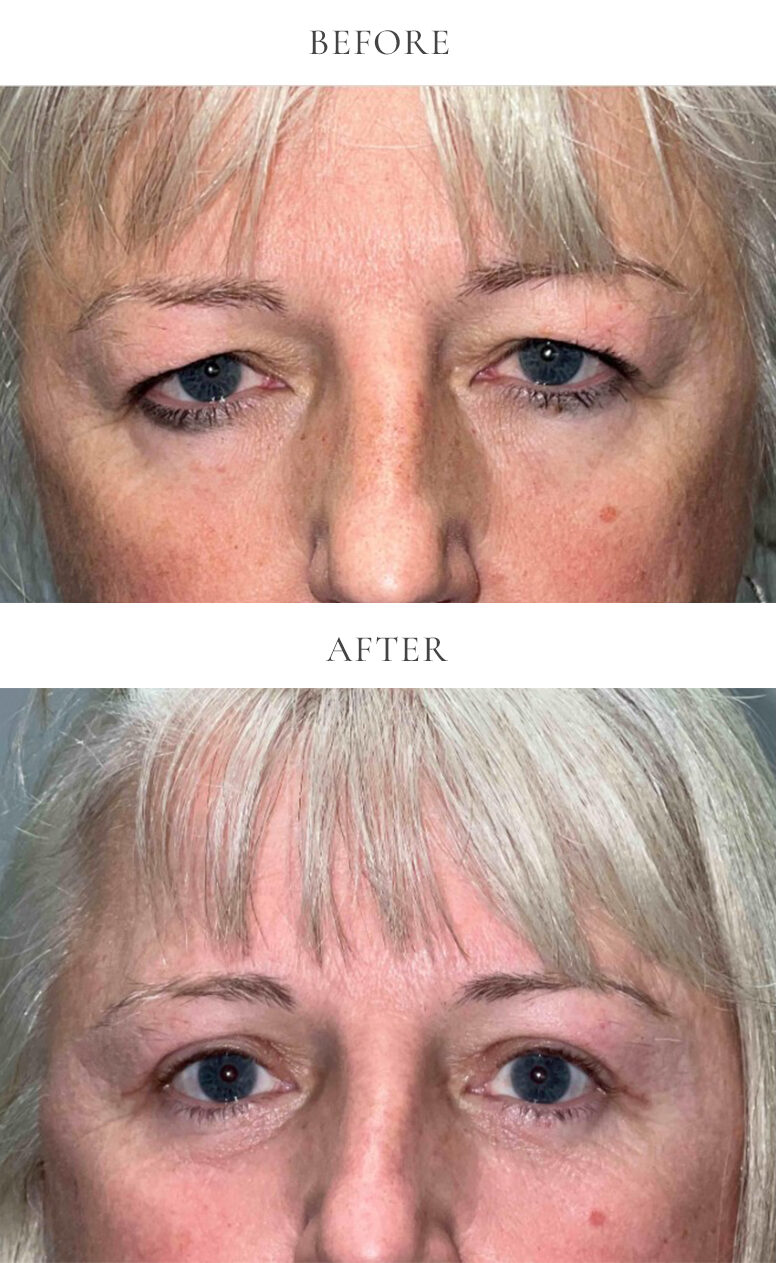 upper eyelid bleph and lower eyelid bleph before and after