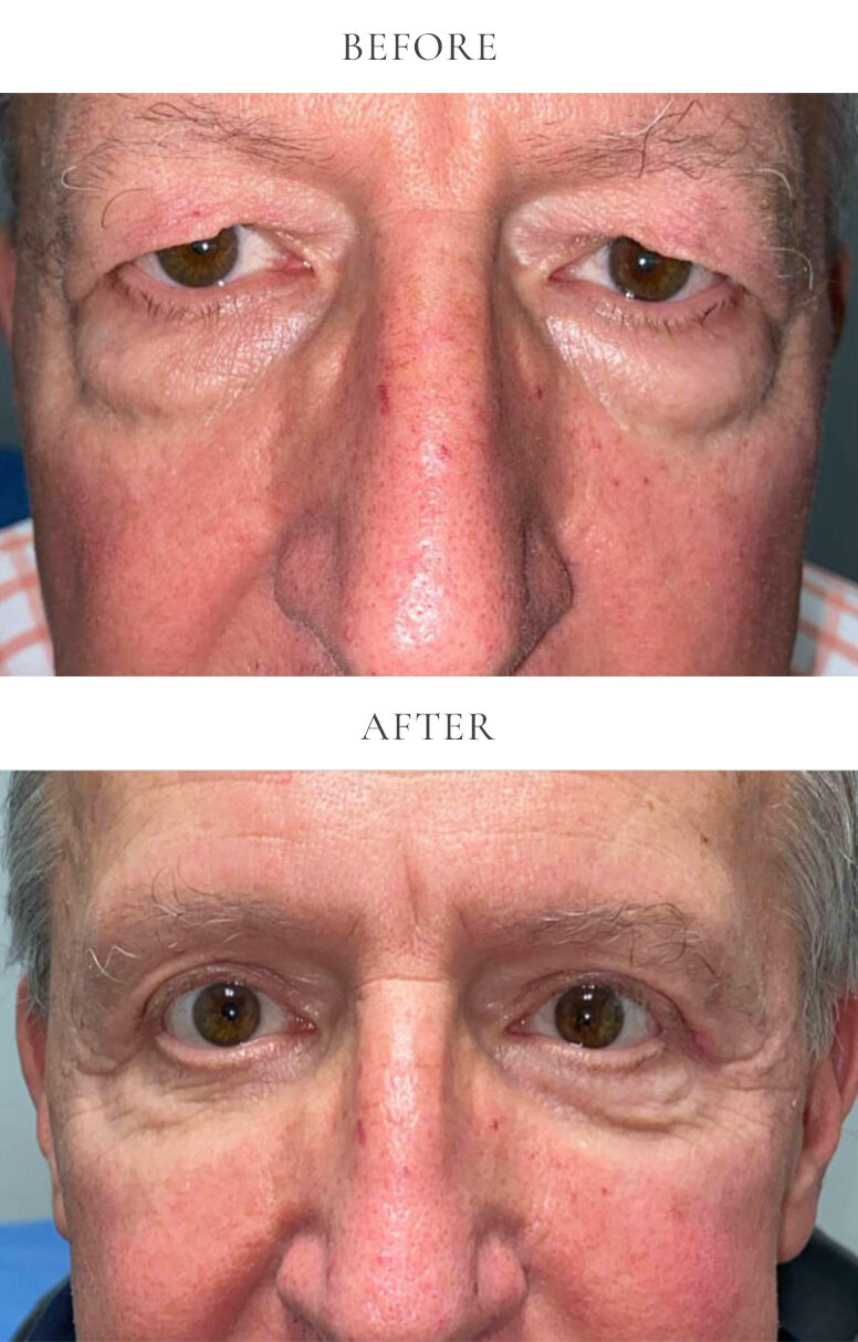 upper eyelid bleph and lower eyelid bleph before and after