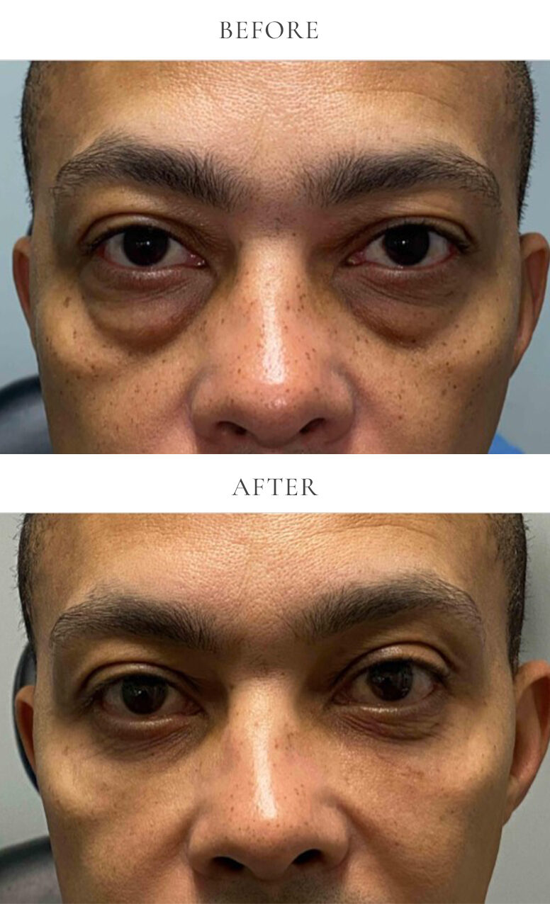 lower eyelid bleph before and after